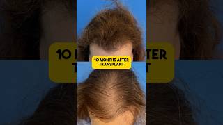 Female Hair Transplant Before & After!