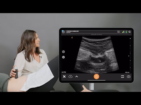 Image of Ultrasound Assessment of the Inter Recti Distance