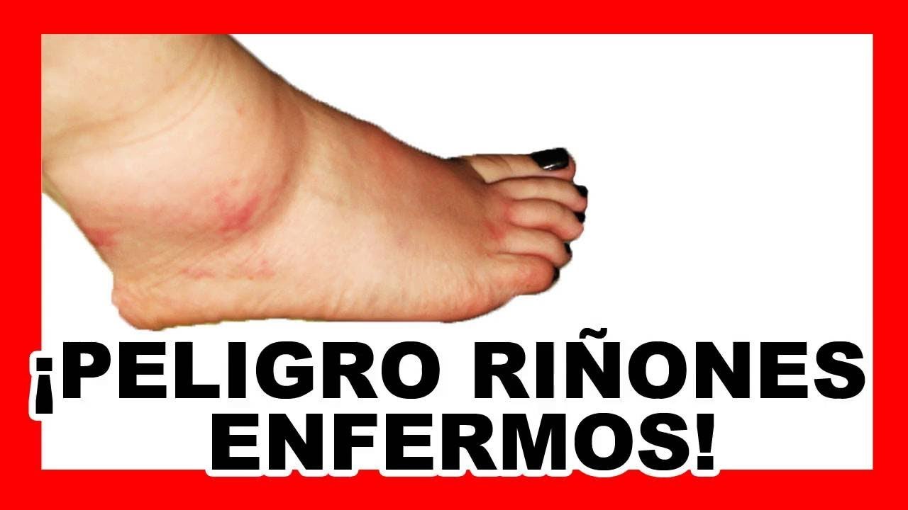 Qué es la nefritis 