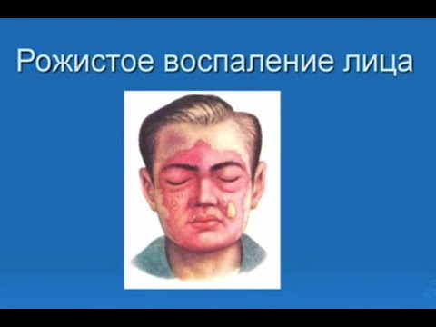 Обучающее видео. Рожистое воспаление