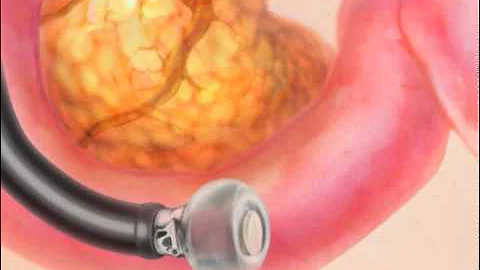 Endoscopic Ultrasound