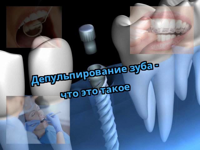 Депульпирование зуба - что это такое