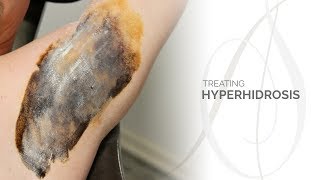 Treating Hyperhidrosis