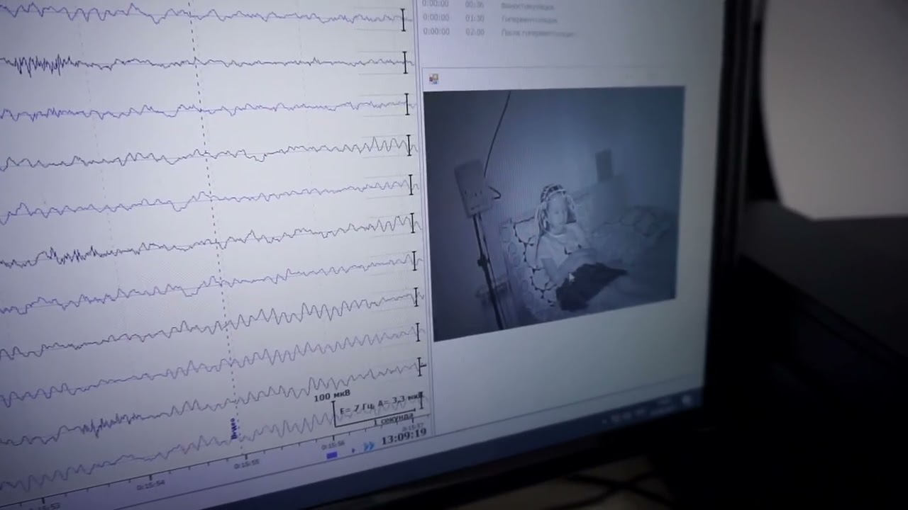 Нега ЭЭГ билан бирга албатта видео хам ёзилиши керак