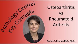 Medical School Pathology: Pathophysiology of Osteoarthritis and Rheumatoid Arthritis