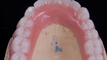 All on 4 implant bar supported denture