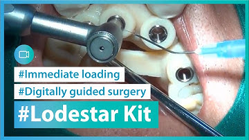 Digitally guided surgery of maxilla multiple placement and immediate loading using Lodestar Kit