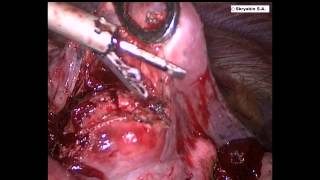 Торакоскопическоей удаление метастаза легкого. Thoracoscopic enucleation of lung metastases.(, 2014-11-13T15:57:20.000Z)