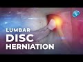 What is lumbar disc herniation  herniated disc