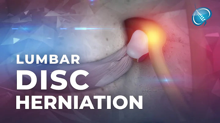What is Lumbar Disc Herniation? | Herniated Disc - DayDayNews