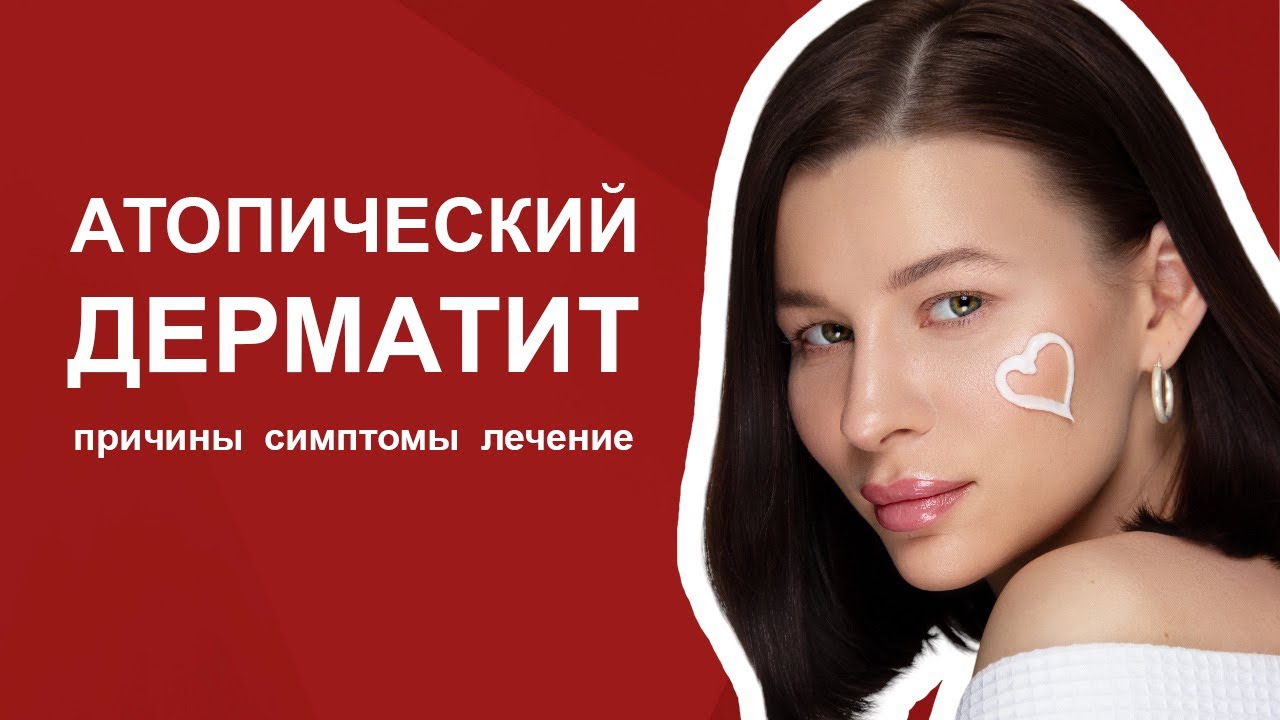 Атопический дерматит. Экзема. Диатез. Симптомы, причины, лечение. - YouTube