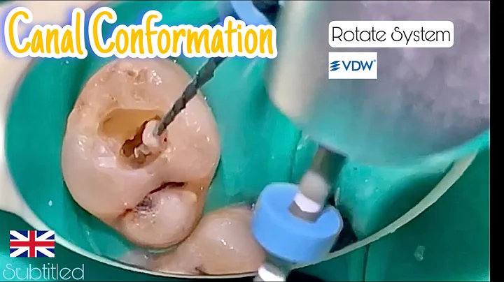 Root canal conformation step by step Rotate system (vdw)
