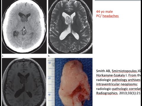 Tumor 94. Subependymoma; ventricular tumor, fourth ventricle