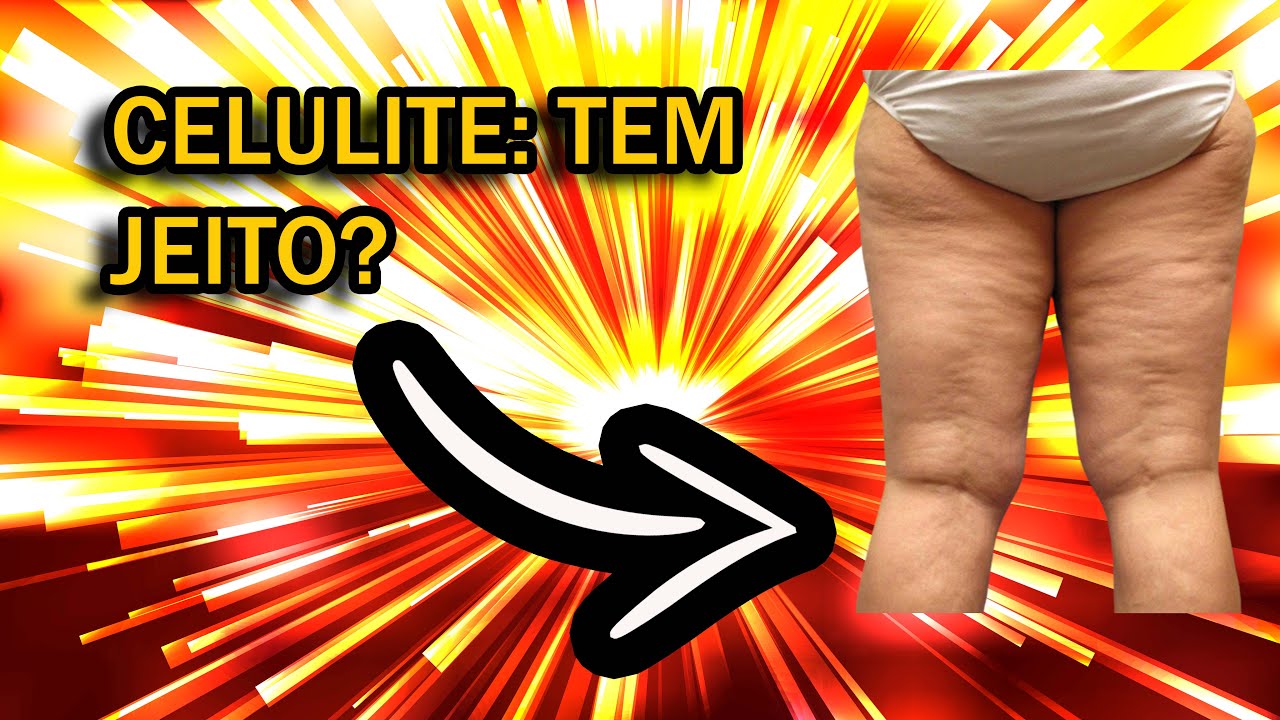 CELULITE COMO MELHORAR DIETA E TREINO AJUDAM YouTube