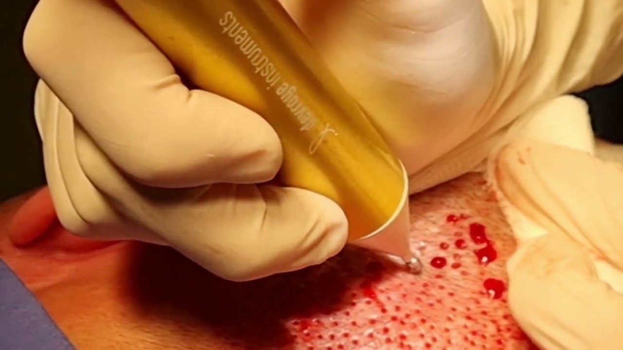 WAW DUO FUE SYSTEM #hairtransplant surgery