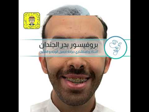 رفع الفك العلوي وتقديم الفك السفلي و الذقن ٦ اشهر من العمليه د بدر الجندان