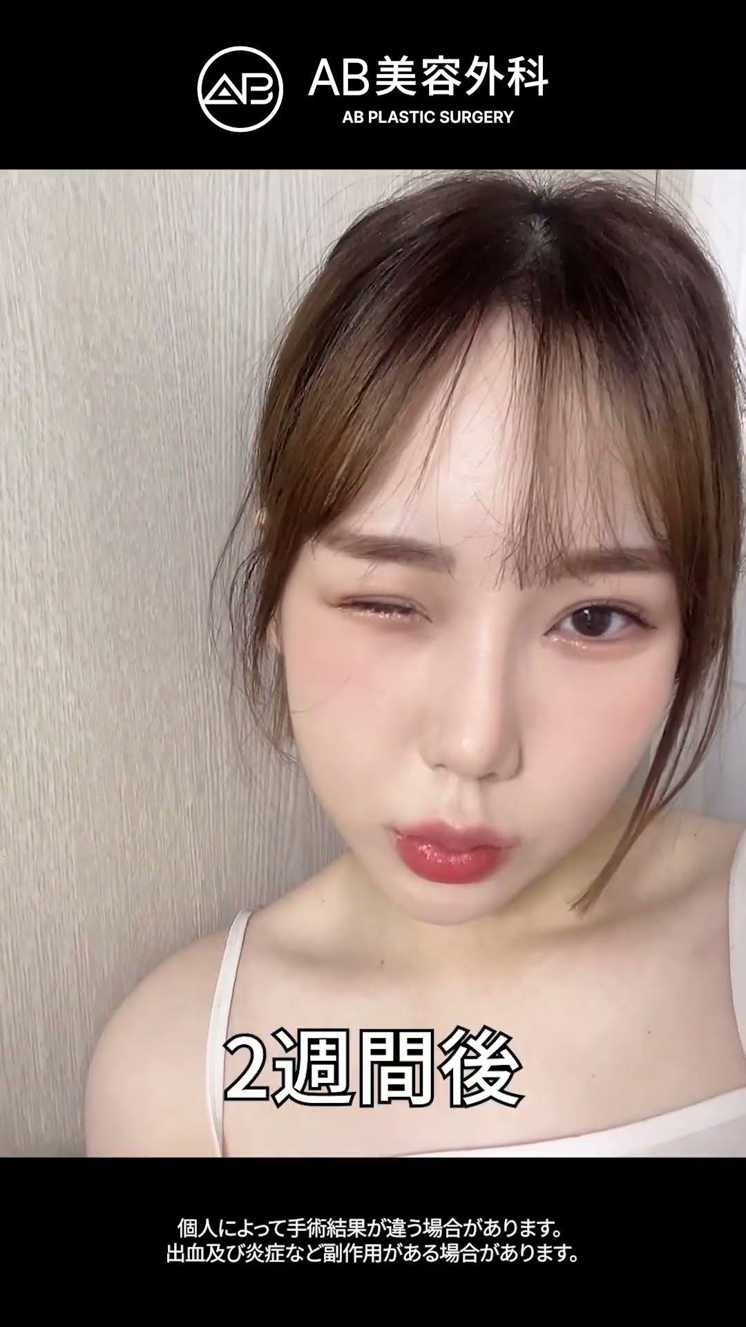 ぱっちり目＆シャープな鼻！究極の美顔変身！ #韓国整形 #美容 #shorts