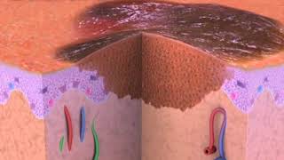 Skin cancer - How skin cancer develops