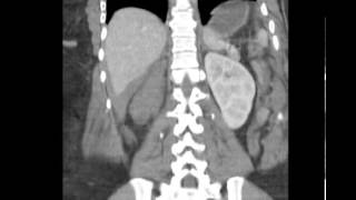 CT Abdomen Trauma w Hepatic laceration Discussed by Radiologist