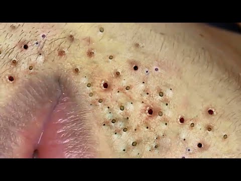 Video: Acne: hvordan man håndterer hudorme