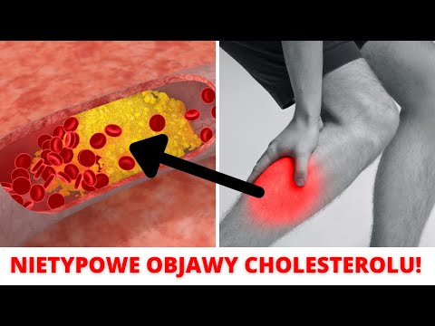 Wysoki CHOLESTEROL: Oznaki Niebezpiecznie WYSOKIEGO poziomu cholesterolu LDL