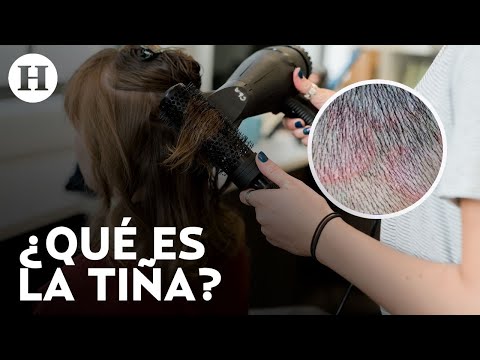 Video: ¿La tiña es una infección por hongos?