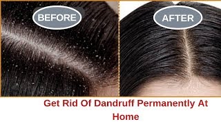 Just 1 Wash To Get Rid Of Dandruff Permanently At Home | 100% works | Dandruff Home Remedy