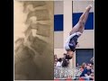 MY SPONDYLOLISTHESIS SPINAL FUSION JOURNEY - 13 Year Old Gymnast - Rise Up!