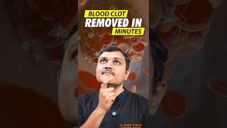 Doctors Reveal the FASTEST Way to Remove Blood Clots