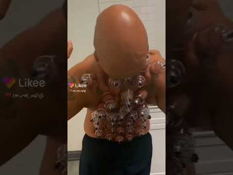 علاج كاسات هوا