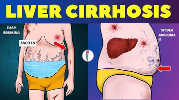 Liver cirrhosis - Warning Signs 🔥 Don