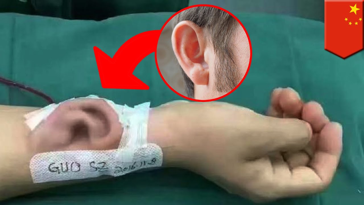 Strange surgery stories Chinese hospital growing man a new ear on his