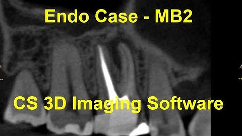 Endodontic Case - MB2 - CS 3D Imaging Software Version 3.10.12