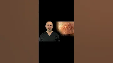 Червь под кожей - дирофиляриоз