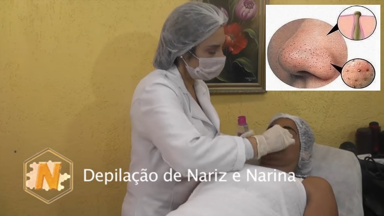 Como Tirar os CRAVOS do Nariz, em 2 Minutos com Cera quente - YouTube