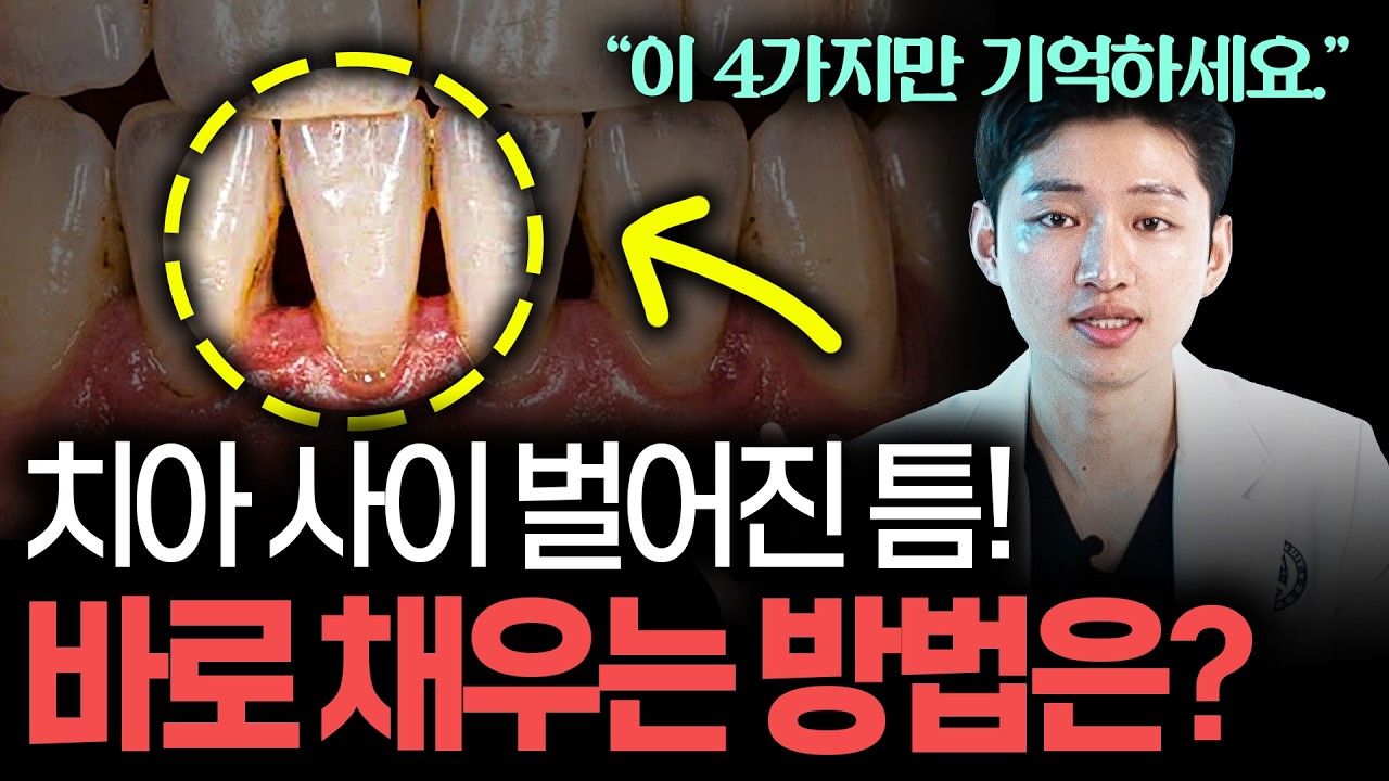 치아 사이에 생긴 틈, 다시 채우는 4가지 방법 싹 다 알려드릴게요 #블랙트라이앵글 | (제발 돈낭비 ㄴㄴ;;)