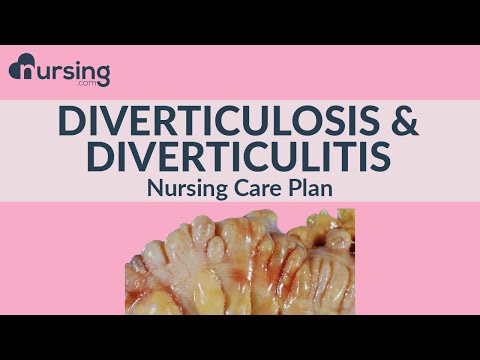 The best way for nurses to care for Diverticulosis and Diverticulitis... Nursing Care Plan