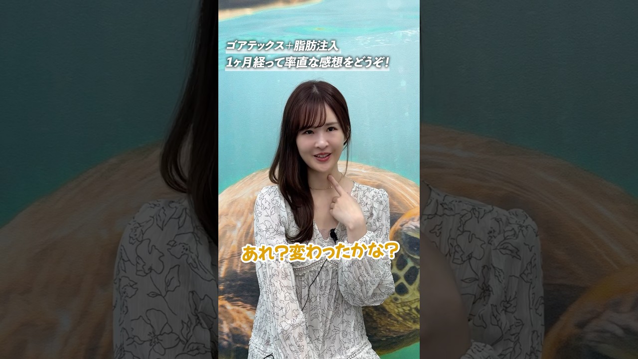 ほうれい線治療から1ヶ月💡