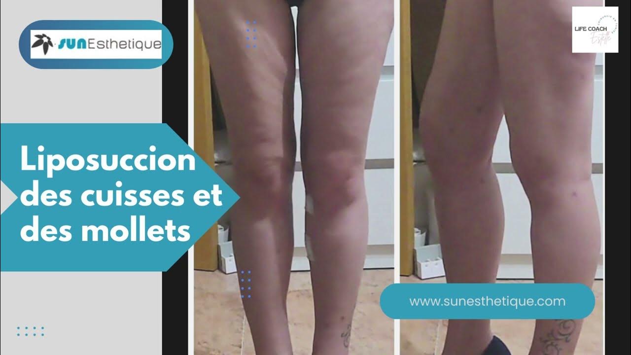 Avant/Après Liposuccion des Cuisses et des Mollets Résultats Impressionnants ! 💪🔥 YouTube
