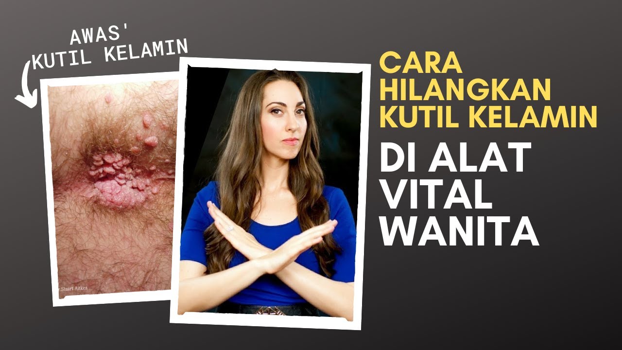 Cara Menghilangkan Kutil Di Alat Kelamin  Wanita  YouTube