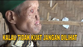 DERITA YANG TAK BERUJUNG...!!! KAKEK PENYANDANG KANKER. Membuat netizen menangis