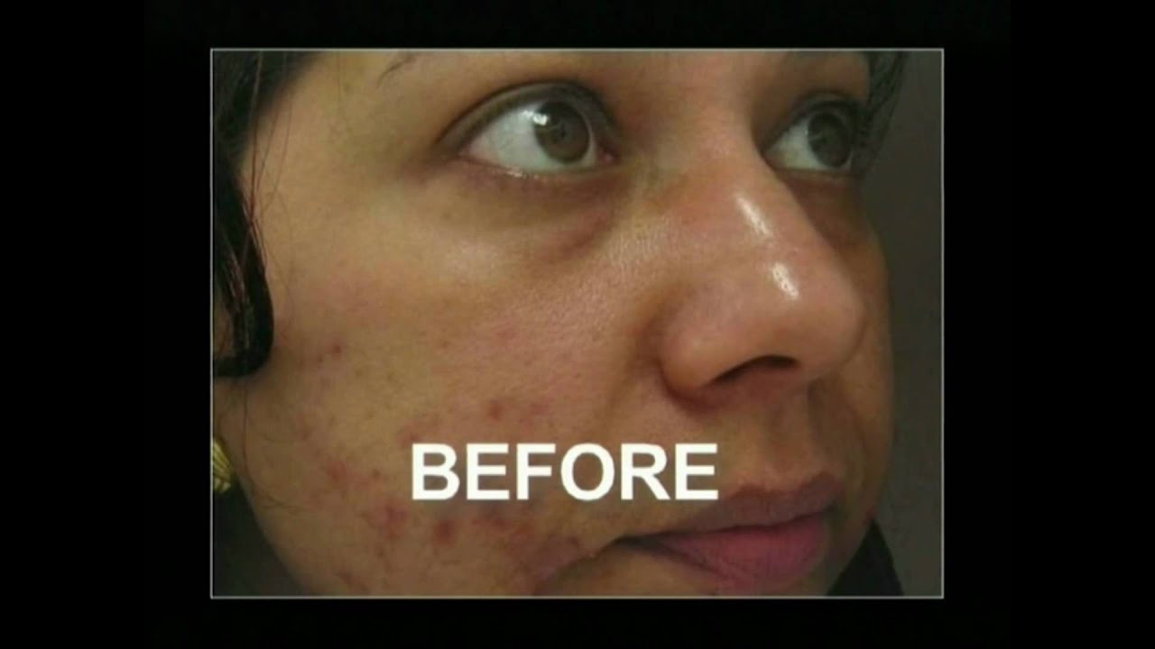 Microdermabrasion for uneven skin tone and acne prone skin YouTube