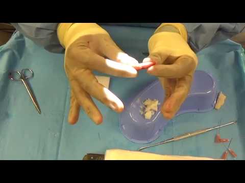 Video thumbnail: Shaved Cartilage Fascia (SCF) graft creation - Plastic Surgery Hacks for DCF graft creation — Dr. Manish H. Shah