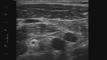 Ultrasound guided costoclavicular brachial plexus block