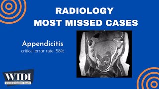 Most Missed Cases: Appendicitis