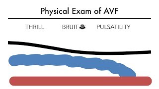 Hemodialysis Access 101 03 - Physical Exam of AVF