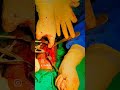 #hospital .Humerus plating
