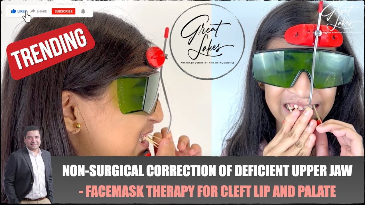 Facemask Appliance Braces NonSurgical Treatment of Small Upper Jaw