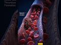 What is a Blood Clot & How Does It Affect Your Body? #3DAnatomy #MedicalAnimation #bloodclots
