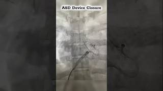 Atrial Septal Defect (ASD) Device Closure #asd #congenitalheartdefects #heart #fluoroscopy